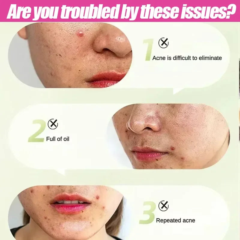 Salicylic Acid  Solution Essence Shrink pores and Acne Spot Removing Shrink Pores Oil-Control Brighten Face Skin Makeup